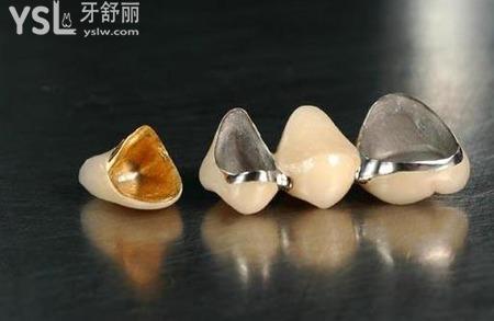 金屬牙和陶瓷牙哪個好？