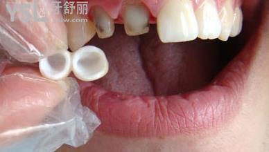 烤瓷牙裝好基牙咬合疼的原因是什么？