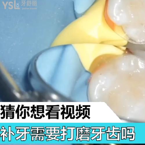 補(bǔ)牙需要打磨牙齒嗎？