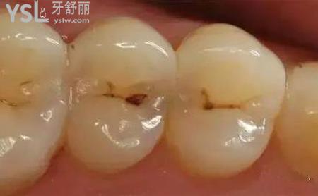 牙齒上有黑點(diǎn)是什么情況？