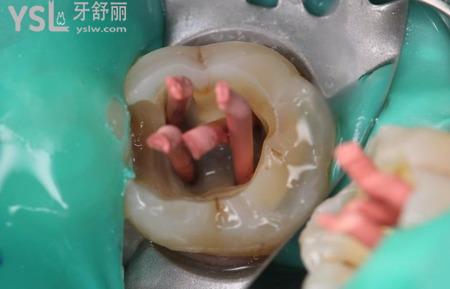 為什么牙髓炎突然不疼了怎么回事？