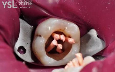 殺完神經(jīng)補(bǔ)牙疼嗎？
