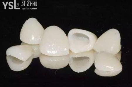全瓷牙的種類有哪些？