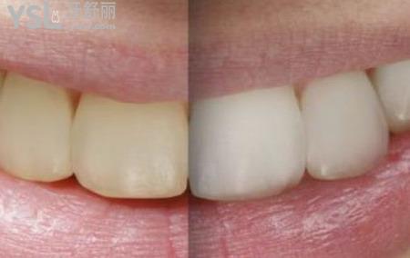 全瓷牙的優(yōu)點(diǎn)有哪些？