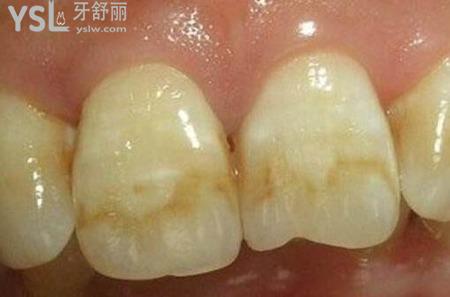 石斑牙怎么治療？