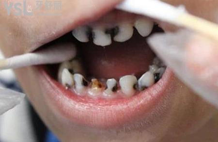 后槽牙里面凹陷處發(fā)黑怎么辦？