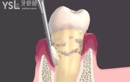 晚期牙周炎的表現(xiàn)是什么樣的？