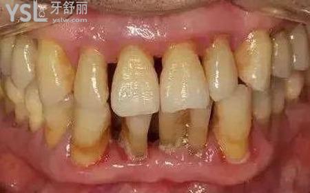 牙齦萎縮疼怎么辦？