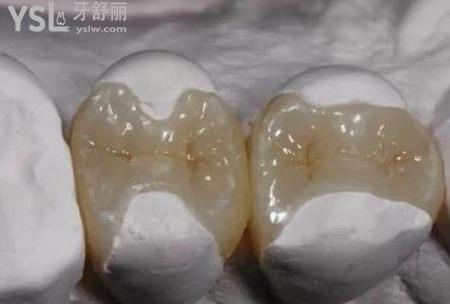 樹脂補牙牢固嗎？