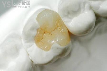樹脂修復(fù)后牙根裸露是怎么回事？