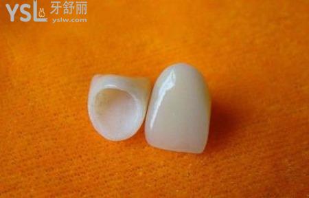 全瓷修復(fù)后注意什么？