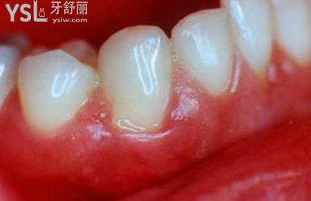 牙齦腫痛怎么回事？