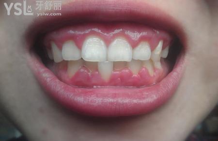 牙齦癢是什么原因？