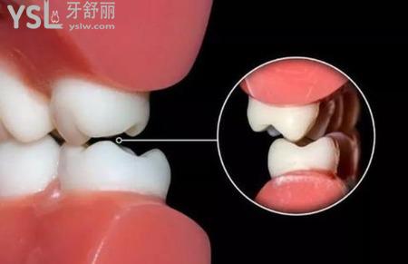 牙后根腫痛怎么回事？