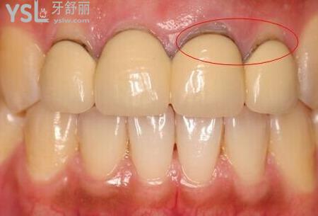 牙根發(fā)黑怎么治療？
