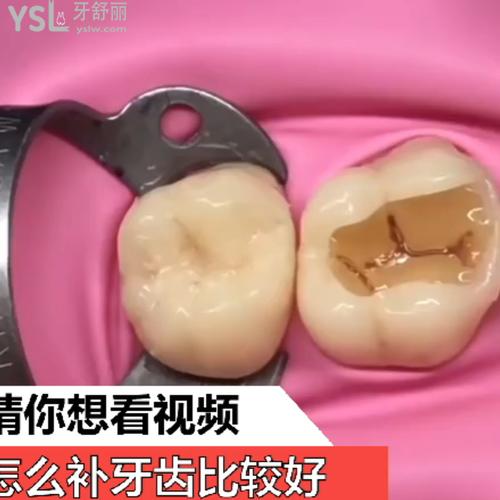 怎么補牙齒比較好？