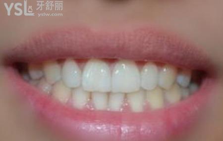 瓷貼面修復(fù)的注意事項有哪些？