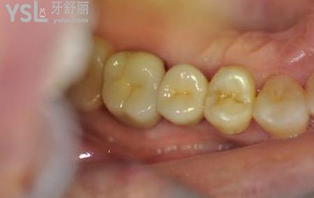 裝活動(dòng)假牙要多久？