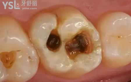 大牙上有黑點是怎么回事？