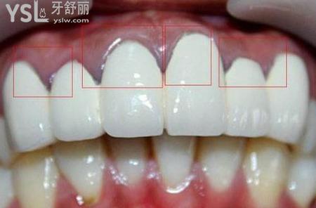 牙齒全掉完了能做烤瓷牙嗎？