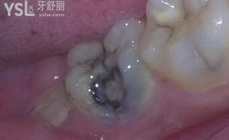 牙齒凹槽上面有黑色怎么去除？