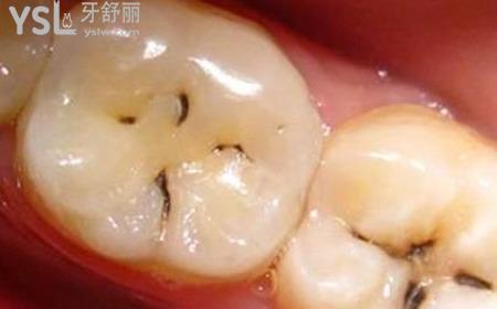 輕度較淺齲齒怎么治療？