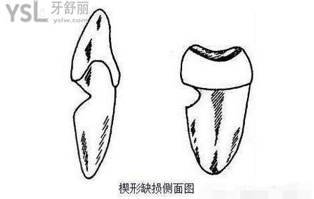 楔狀缺損補牙多少錢？