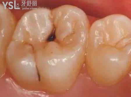 蛀牙會傳染相鄰的牙嗎？
