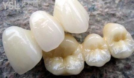 陶瓷牙一顆多少錢？