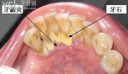 洗牙結(jié)石需要多少錢？