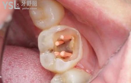 牙齒根管治療是怎么回事？
