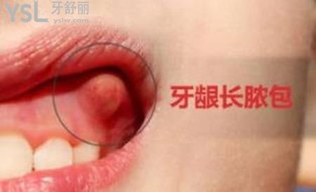 牙銀上長個(gè)膿包怎么辦？