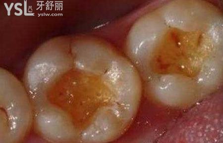 補蛀牙的價格是多少？