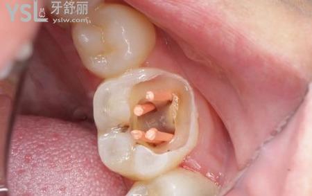 牙科根管治療是什么？
