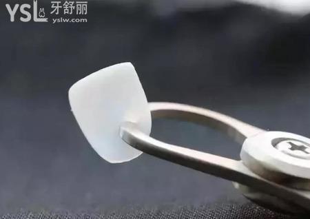 牙貼面能維持多久？