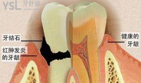 牙周炎有什么癥狀？