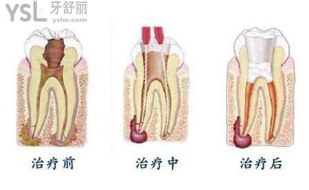 根管治療第二次做什么？