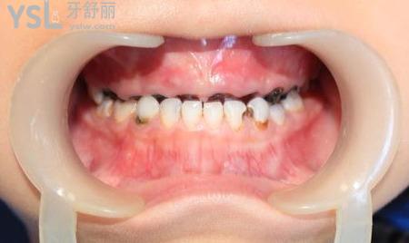 牙根黑了怎么治療？