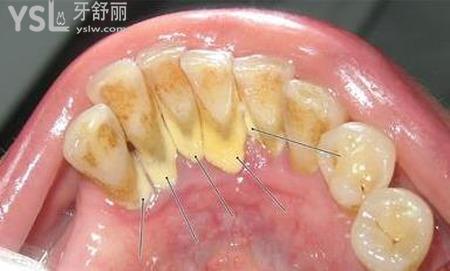 牙齒上有黃垢怎么辦？
