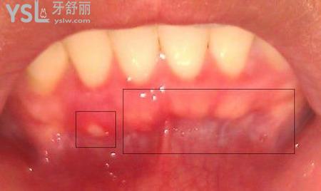 牙齦腫痛不能吃什么東西？