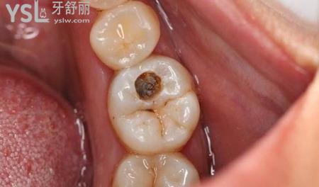 齲齒會痛嗎？