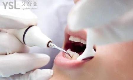 洗牙兩小時(shí)后能抽煙嗎？