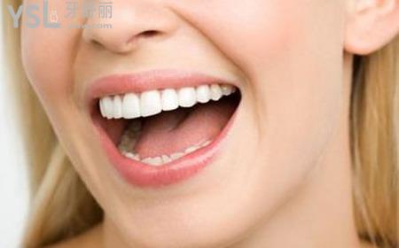 美容冠矯正牙齒多少錢？