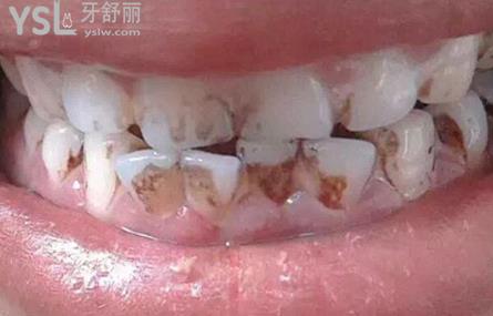 牙齒不好是怎么回事？