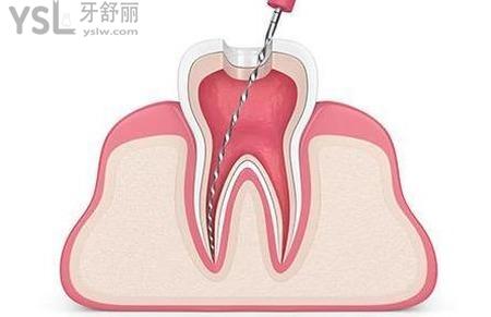 牙神經(jīng)疼的好的怎么辦？