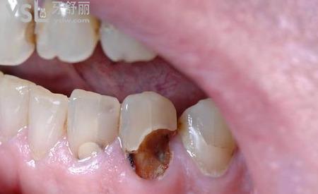 牙齒根部發(fā)炎怎么治療？