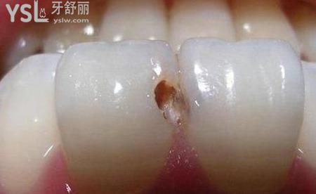 兩個(gè)牙齒之間的根部有洞,該怎么處理？