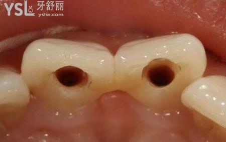 牙根尖炎能自愈嗎 牙尖根炎該怎么治療？