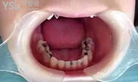 我的一顆大牙爛掉了一半了,應(yīng)該怎么辦？