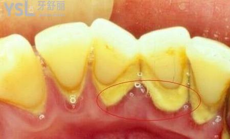 牙結(jié)石清除價格是多少?